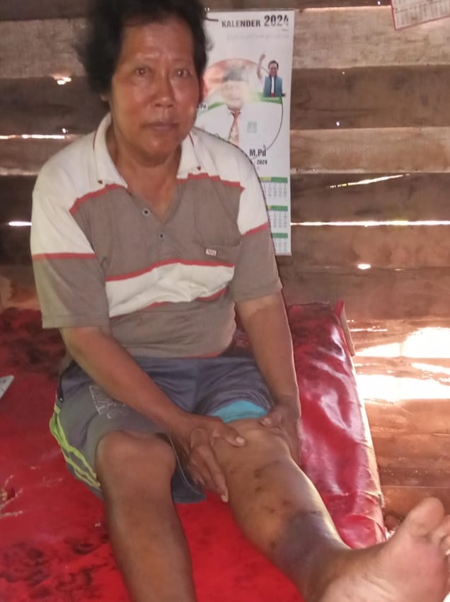 Hariyono Tuban Butuh Bantuan, Tak Punya Biaya untuk Operasi Kaki di Solo